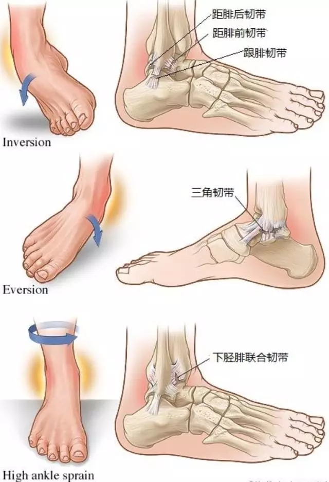 较少见的外翻性应力